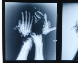 Mandatory Credit: Photo by HAP/Quirky China News/Rex/REX USA (1886510f) X-Ray of Wang Jin's mutilated hands Surgeons create new 'pincer' hands after worker is mutilated in accident, Changsha, Hunan, China - 24 Dec 2013 A Chinese hospital has made a pair of